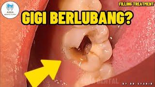 Gigi Berlubang  Tampalan Gigi  Fillings  Dentist  Adda Dental Clinic