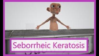 Seborrheic Keratosis Mnemonic for the USMLE