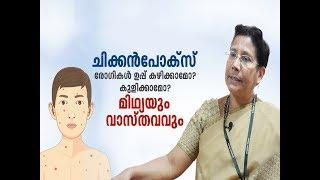 ചിക്കൻപോക്സ് മിഥ്യയും വാസ്തവവും  Chicken Pox