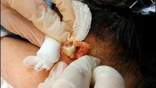 Pimple Popping Complication 2018