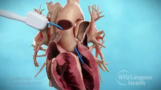 Septal Myectomy and Residual Leaflet Excision for Hypertrophic Cardiomyopathy