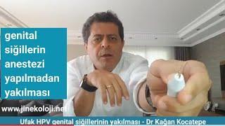 Genital siğiller HPV kondilom anestezi yapmadanuyuşturmaya gerek olmadan ağrısız yakılabilir mi?