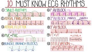 Most Common ECG Patterns You Should Know