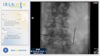 Watch Live Back Treatment DLDR RT L3-L4 LT L4-L5 + Deuk Plasma Rhizotomy DPR RT L3-S1