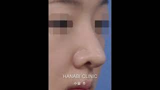 하나비 복코성형 전후사례 #코성형 #복코성형