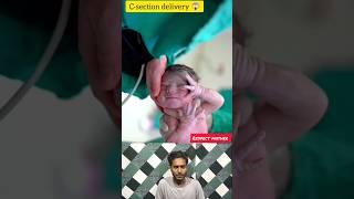 C-section delivery baby birth  #junior #birth #respectmother #cutebaby #babycare #shorts #viral