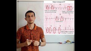 Расшифровка ЭКГ при инфаркте миокарда