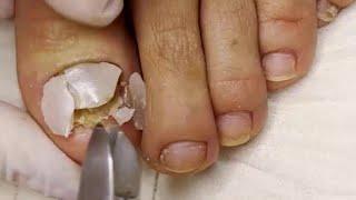 Fungal Nail with Dried Abscess  Ingrown Nail Treatment  Thick Fungal Toenail