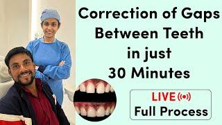 Correction of Gaps Between Teeth  दांतों का गैप भरने का पूरा प्रॉसेस देखिये Live Dr. Vishakha Jain