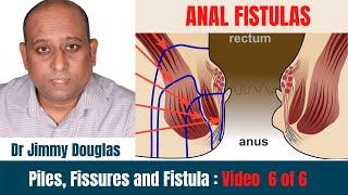 What is Anal Fistula ? Causes  symptoms Prevention  Diagnosis and Treatment