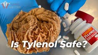 Should You Stop Taking Tylenol? AcetaminophenParacetamol