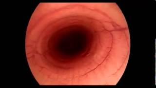 Equine Upper AirwaySinus endoscopy procedure