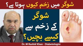 Sugar Ka Zakham Ka Ilaj  Diabetic Foot Problems In Urdu  Sugar Ki Bimari  Diabetes Complications