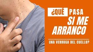 ¿Qué pasa si me ARRANCO una VERRUGA DEL CUELLO?