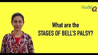 WHAT ARE DIFFERENT STAGES OF BELLS PALSY