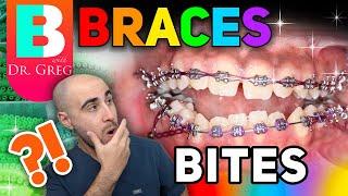 Braces Overbite Overjet Underbite Crossbite & Open Bite Explained