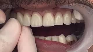 Diş Kaplaması Lamine Diş Nasıl Yapılır?  Dentram