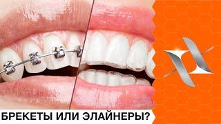 Брекеты или элайнеры?