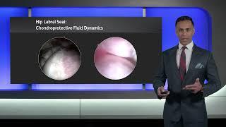 Revision Osteochondroplasty for an Overresected Femoral Neck