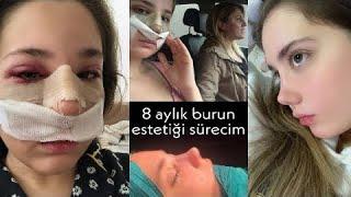 BURUN ESTETİĞİ OLDUM 8 aylık sonuç fiyatlar ameliyat süreci ödem atma nelere dikkat ettim