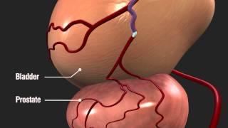 Prostatic Artery Embolization PAE with Magellan Robotic System