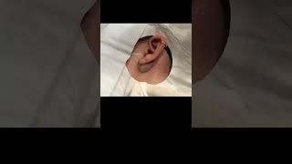 Inflamed cyst behind the ear #drpimplepopper #pimplepopper #SLMDskincare