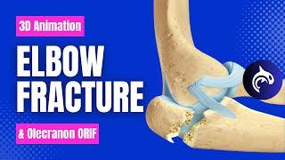 Elbow Olecranon Fracture and Fixation - 3D Animation