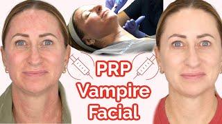 Microneedling PRP FACIAL Experience BEFOREAFTER Vampire Facial  {Over 40}