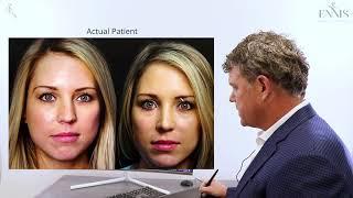 Rhinoplasty and What People Perceive as Pretty in a Nose