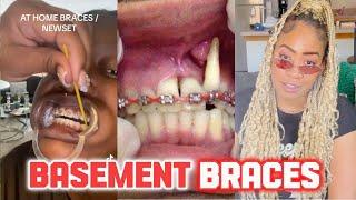 When cheap braces go wrong #diy #diycrafts #braces #dental #dentalimplants