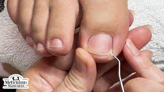 Deep Sidewall Toenail Cleaning #nails #satisfying