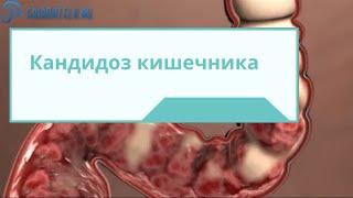 Кандидоз кишечника виды симптомы диагностика и лечение болезни