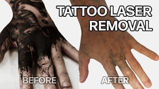 WHY DID I LASER OFF ALL MY TATTOOS?  TATTOO LASER REMOVAL