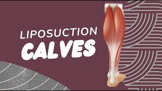 Correcting Irregularities on the Calves with Liposuction from a previous surgery at another office