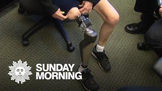 A giant step forward in artificial legs
