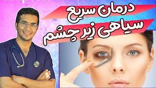 How To Get Rid Of Dark Circles Under Eyes Fast درمان فوری سیاهی زیر چشم ها