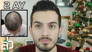 Doktor Genetik Saç Dökülmesi Var  dedi  2 Ayda Saçlarımı Nasıl İyileştirdim ? │ Aras Barlas