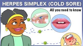 Herpes simplex Cold sore All you need to know