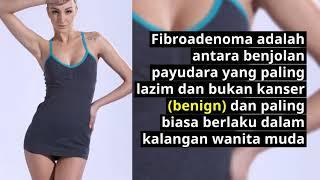 Apakah Itu Fibroadenoma Di Payudara Penyebab Serta Gejalanya Breast Fibroadenoma