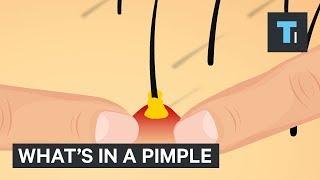 Whats Inside A Pimple?