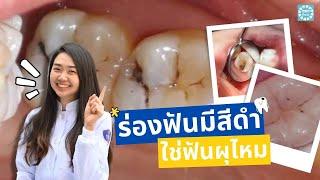 ร่องฟันมีสีดำ ใช่ฟันผุไหมนะ  คลิปนี้หมอหญิงมีคำตอบ