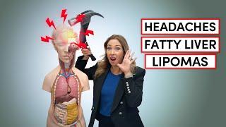 HeadachesFatty Liver Lipomas  Dr. Janine