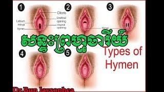 ​ប្រភេទ សន្ទះ ព្រហ្មចារី​យ៍​ Type of Hymen by Dr.bun laysophea