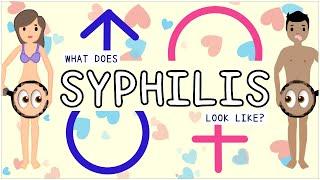 Syphilis Types Sign and symptoms Diagnosis Treatment