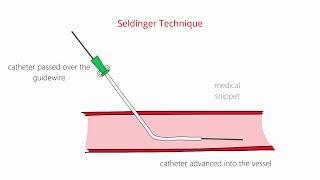 Seldinger Technique & Modified Seldinger Technique