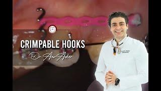 Step bye step crimpable hooks placement+En-masse retraction in Orthodontics Asker Orthodontics