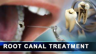 Root Canal Treatment step by step   Curveia Dental Animation in 3D - Endodontics for tooth decay