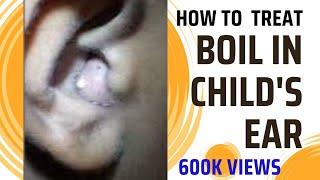 Boil in childs ear Furuncle in Childs Ear. कानाचे आजार  #Boil #earinfection