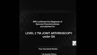 Arthroscopy of TM Joint Synovial Chrondromatosis by Dr.Kaushik Pethani