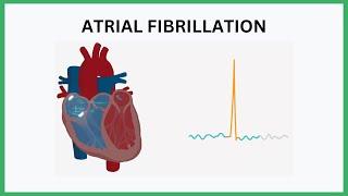 ECG 4 Atrial Fibrillation